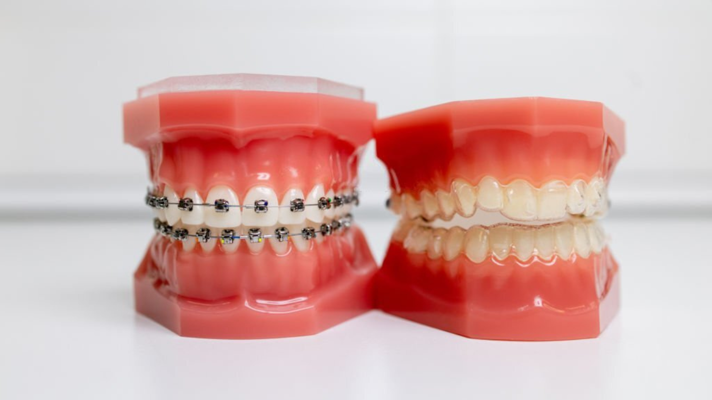 Everything you need to know about rubber bands and braces